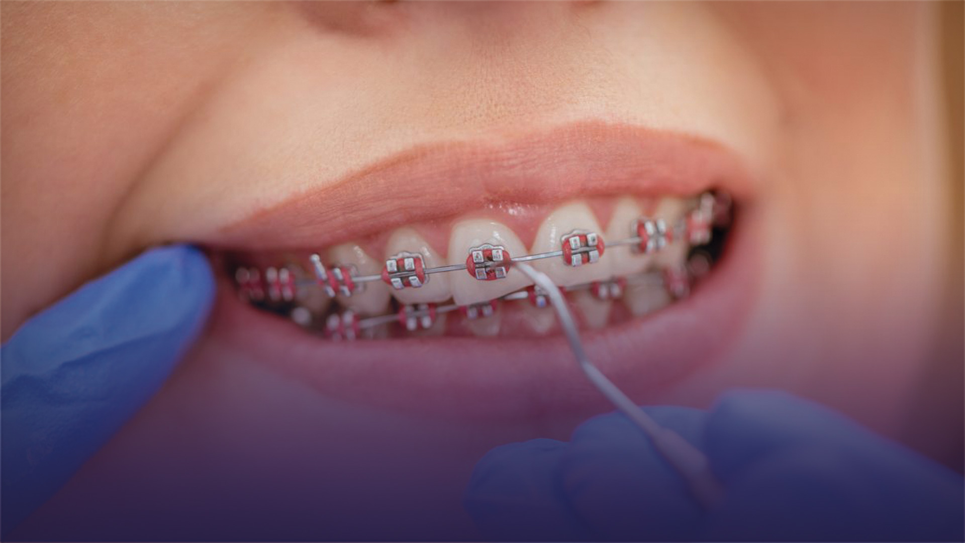 Ortodonti veya Diş Teli Tedavisini Kim Yapmalı?