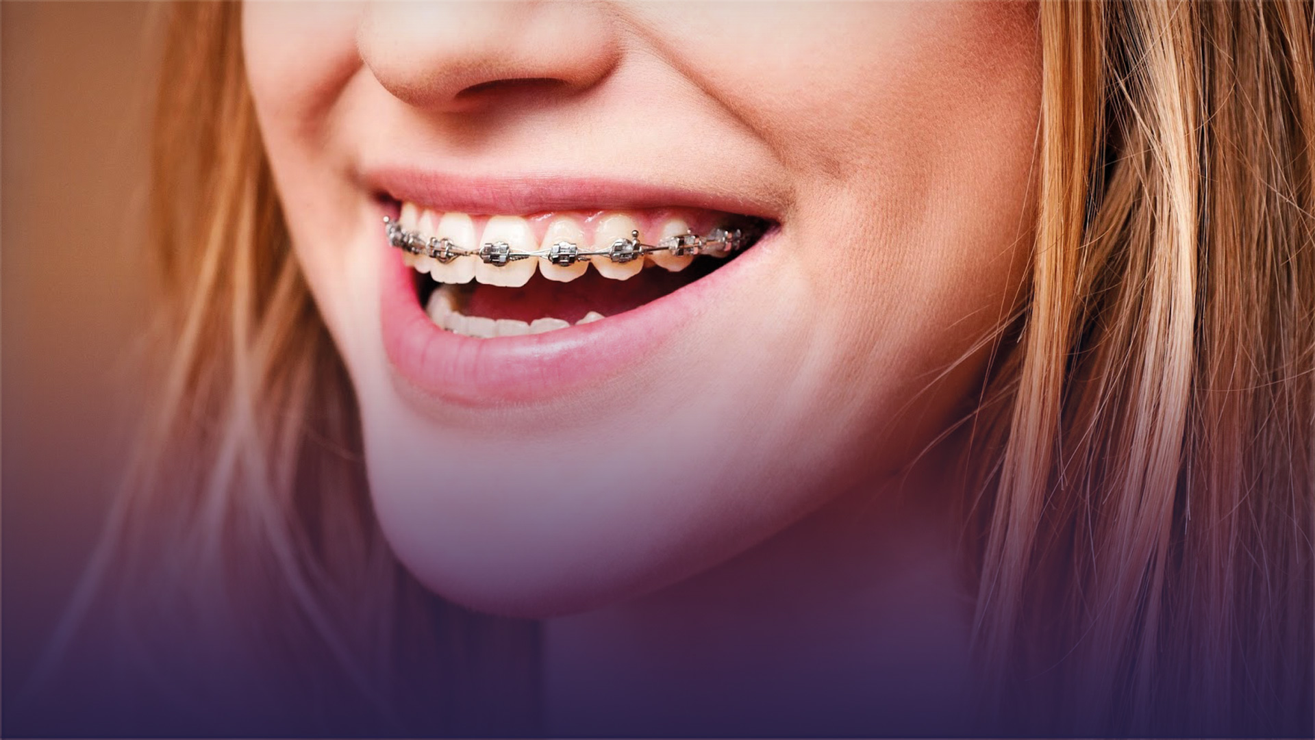 Ortodontik Tedavi (Diş Teli) Pahalı mı….?